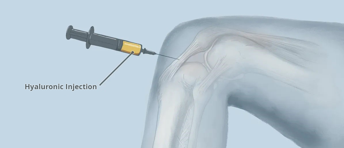 PRP Injection PRP Injection